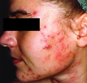 Acne due to steroids
