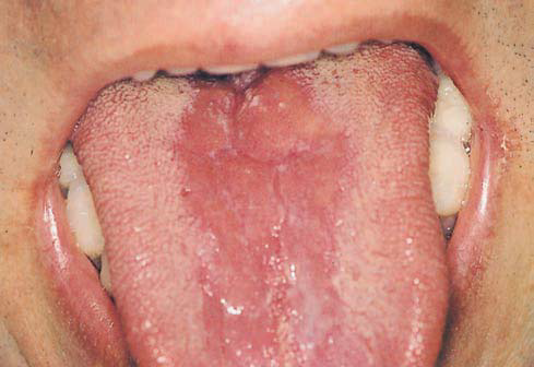 Geographic Tongue: Home Remedies, Causes, Symptoms ...